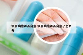 銀屑病擦蘆薈自愈 銀屑病擦蘆薈自愈了怎么辦
