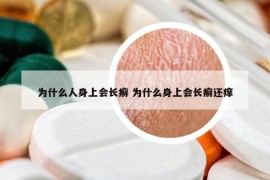 為什么人身上會長癬 為什么身上會長癬還癢