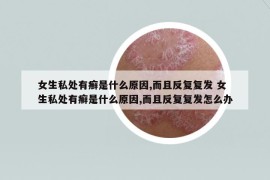 女生私處有癬是什么原因,而且反復(fù)復(fù)發(fā) 女生私處有癬是什么原因,而且反復(fù)復(fù)發(fā)怎么辦