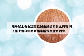 孩子腿上有白斑而且越來越長用什么藥膏 孩子腿上有白斑而且越來越長用什么藥膏