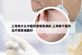 上海有什么中醫(yī)院看銀屑病的 上海哪個醫(yī)院治療銀屑病最好