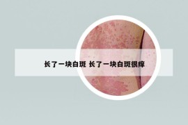 長了一塊白斑 長了一塊白斑很癢