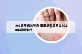 301銀屑病關(guān)節(jié)炎 銀屑病型關(guān)節(jié)炎2020年最新治療