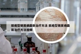 膿皰型銀屑病最新治療方法 膿皰型銀屑病最新治療方法視頻