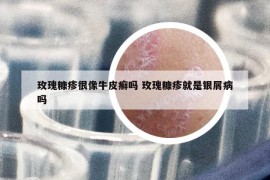 玫瑰糠疹很像牛皮癬嗎 玫瑰糠疹就是銀屑病嗎