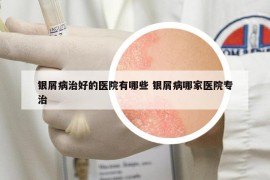 銀屑病治好的醫(yī)院有哪些 銀屑病哪家醫(yī)院專治