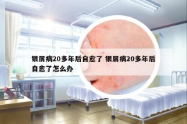 銀屑病20多年后自愈了 銀屑病20多年后自愈了怎么辦