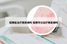 硫磺能治療銀屑病嗎 硫磺可以治療銀屑病嗎
