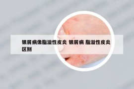 銀屑病像脂溢性皮炎 銀屑病 脂溢性皮炎 區(qū)別