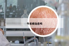 牛皮癬治愈嗎
