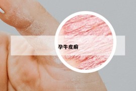 孕牛皮癬
