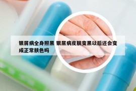 銀屑病全身照黑 銀屑病皮膚變黑以后還會變成正常膚色嗎