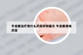 牛皮廨治療用什么藥膏好和偏方 牛皮廨用啥藥膏