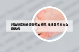托法替尼和魯索替尼白癜風 托法替尼能治白巔風嗎