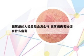 銀屑病的人吸毒后會怎么樣 銀屑病患者抽煙有什么危害