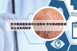 懷孕期間銀屑病可以消失嗎 懷孕期間銀屑病可以消失嗎知乎