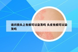 請問我頭上有癬可以染發(fā)嗎 頭皮有癬可以染發(fā)嗎