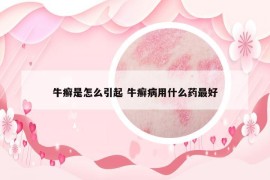 牛癬是怎么引起 牛癬病用什么藥最好