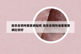 南京皮研所銀屑病貼吧 南京皮研所誰看銀屑病比較好