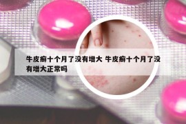 牛皮癬十個(gè)月了沒(méi)有增大 牛皮癬十個(gè)月了沒(méi)有增大正常嗎