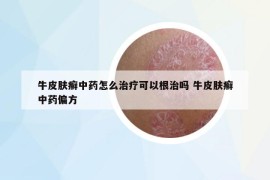 牛皮膚癬中藥怎么治療可以根治嗎 牛皮膚癬中藥偏方
