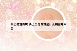 頭上出現(xiàn)白斑 頭上出現(xiàn)白斑是什么病圖片大全