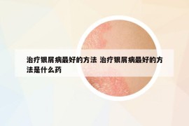 治療銀屑病最好的方法 治療銀屑病最好的方法是什么藥