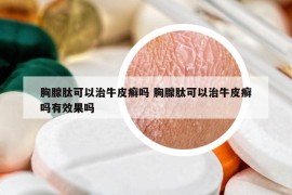 胸腺肽可以治牛皮癬嗎 胸腺肽可以治牛皮癬嗎有效果嗎