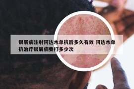 銀屑病注射阿達(dá)木單抗后多久有效 阿達(dá)木單抗治療銀屑病要打多少次