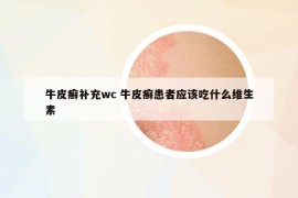 牛皮癬補充wc 牛皮癬患者應(yīng)該吃什么維生素
