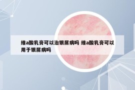 維a酸乳膏可以治銀屑病嗎 維a酸乳膏可以用于銀屑病嗎