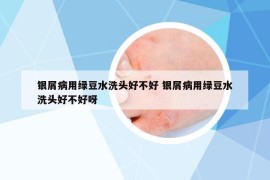 銀屑病用綠豆水洗頭好不好 銀屑病用綠豆水洗頭好不好呀