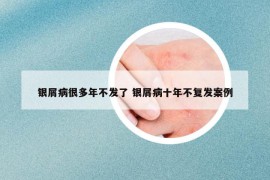 銀屑病很多年不發(fā)了 銀屑病十年不復(fù)發(fā)案例