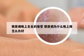 銀屑病晚上無名的難受 銀屑病為什么晚上癢怎么辦好