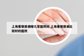 上?？淬y屑病哪幾家醫(yī)院好 上海看銀屑病比較好的醫(yī)院