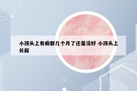小孩頭上有癬都幾個(gè)月了還是沒(méi)好 小孩頭上長(zhǎng)蘚