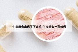 牛皮癬會(huì)永遠(yuǎn)不下去嗎 牛皮癬會(huì)一直長嗎