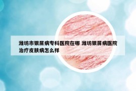 濰坊市銀屑病專科醫(yī)院在哪 濰坊銀屑病醫(yī)院治療皮膚病怎么樣