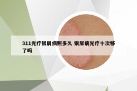 311光療銀屑病照多久 銀屑病光療十次夠了嗎