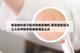 新裝修的房子能誘發(fā)銀屑病嗎 新房裝修后馬上入住甲醛導(dǎo)致銀屑病怎么辦
