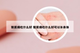 銀屑病吃什么好 銀屑病吃什么好可以補(bǔ)身體