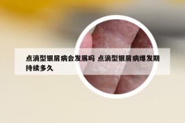 點(diǎn)滴型銀屑病會(huì)發(fā)展嗎 點(diǎn)滴型銀屑病爆發(fā)期持續(xù)多久