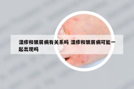 濕疹和銀屑病有關(guān)系嗎 濕疹和銀屑病可能一起出現(xiàn)嗎