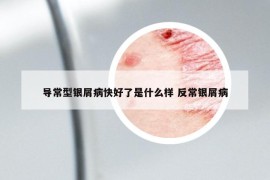導(dǎo)常型銀屑病快好了是什么樣 反常銀屑病