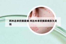 阿木達(dá)單抗銀屑病 阿達(dá)木單抗銀屑病多久見效