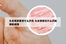 頭皮銀屑要用什么藥膏 頭皮銀屑吃什么藥能緩解病情
