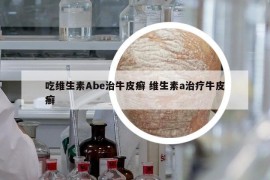 吃維生素Abe治牛皮癬 維生素a治療牛皮癬