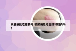 銀屑病能吃臘腸嗎 銀屑病能吃香腸和臘肉嗎?