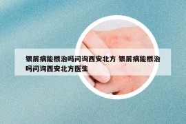 銀屑病能根治嗎問詢西安北方 銀屑病能根治嗎問詢西安北方醫(yī)生