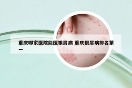 重慶哪家醫(yī)院能醫(yī)銀屑病 重慶銀屑病排名第一